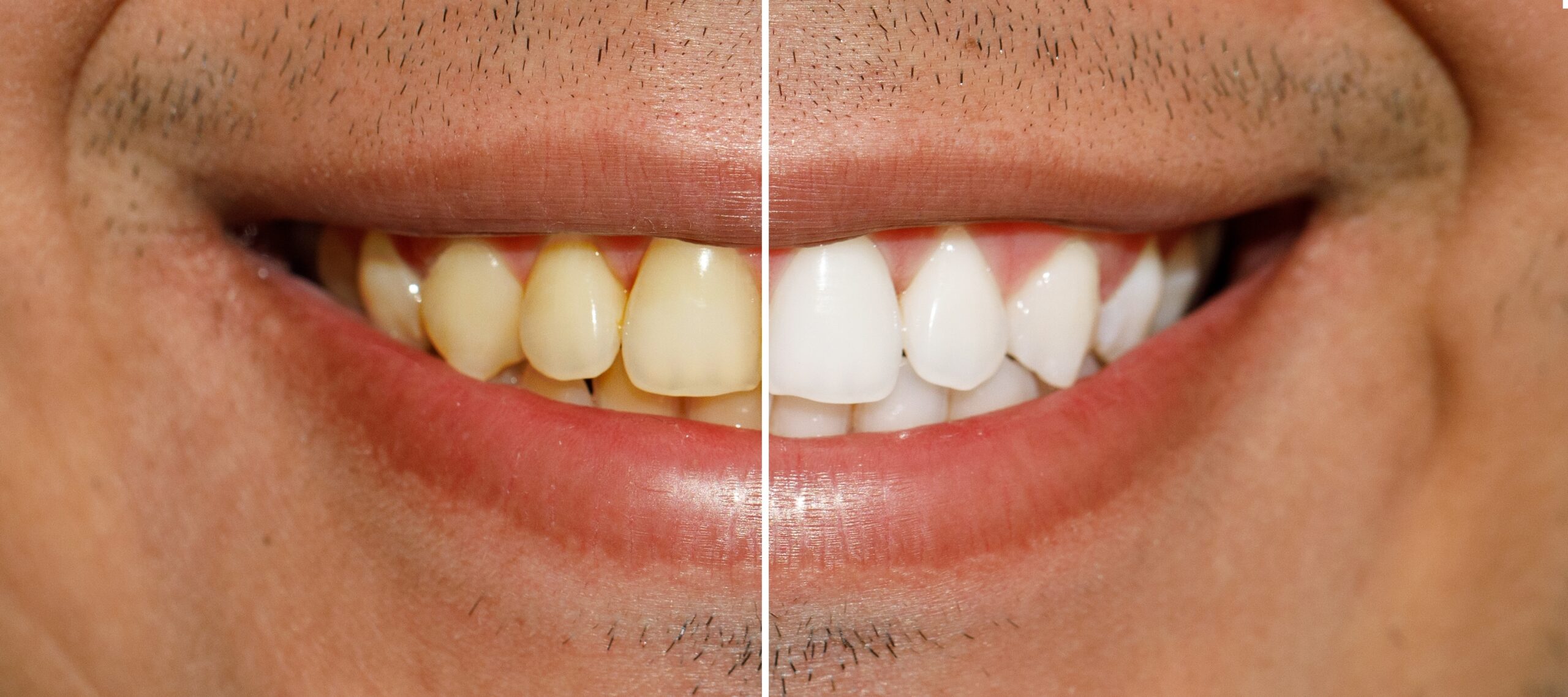 professional teeth whitening before and after from Decatur Smiles