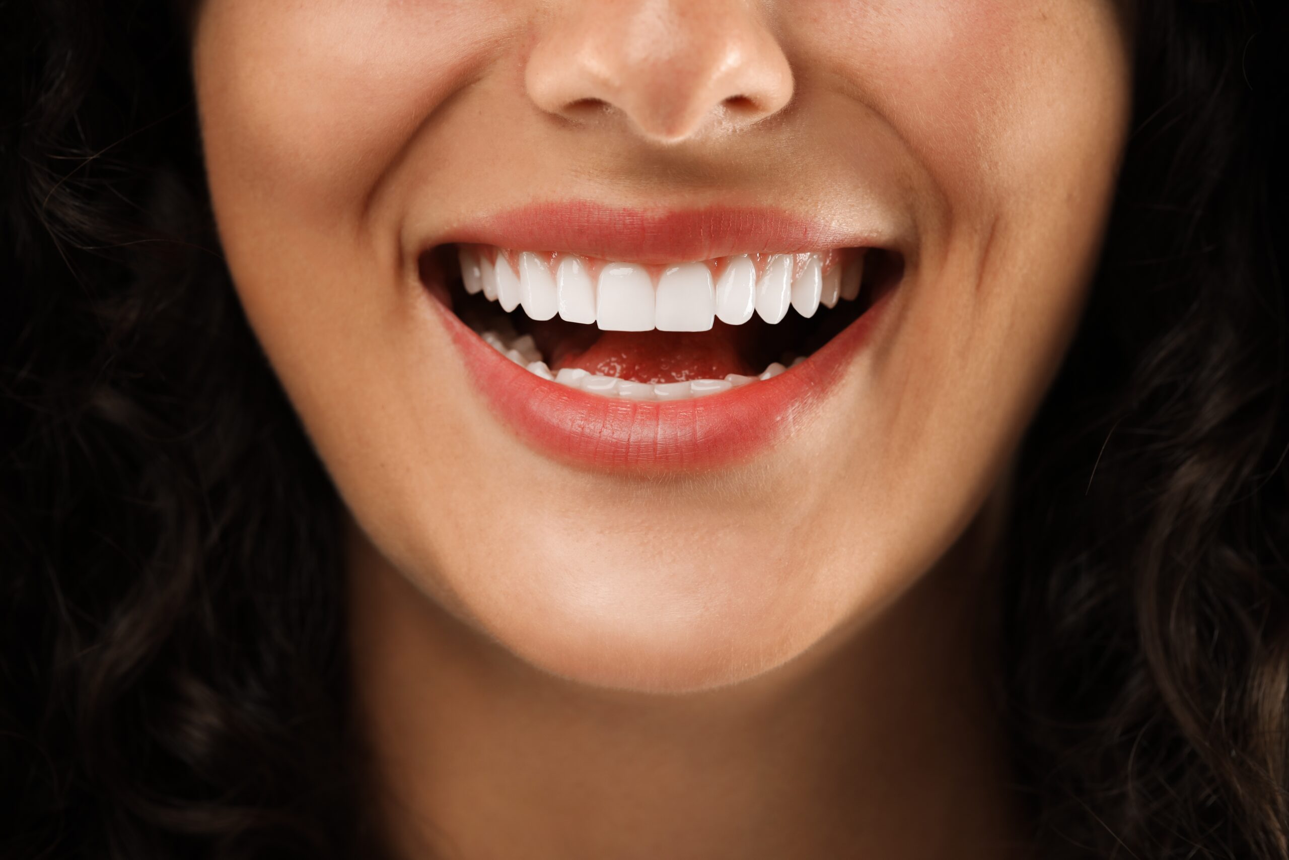 closeup of a woman smiling, showcasing her dental veneers