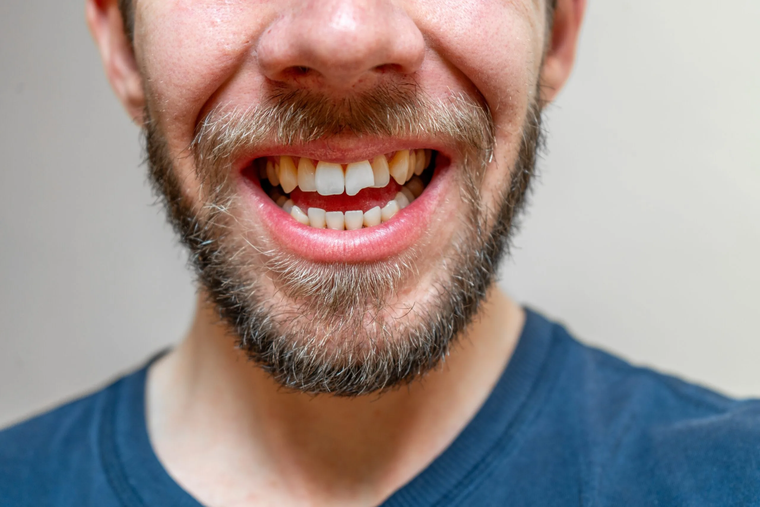 man in a blue shirt with a chipped front tooth