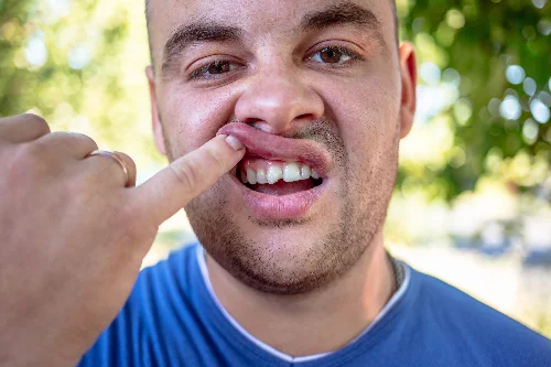man in a blue shirt exposing a chipped tooth